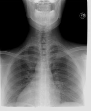 x 射线, 胸椎, 诊断