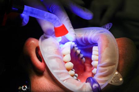 牙医, 小关节, uv 灯, 固化, 牙齿, 嘴里, 治疗