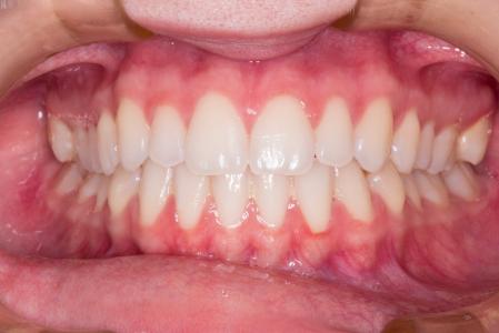 牙齿, 微笑, 牙医, 人类的牙齿, 人的嘴唇上, 人类的嘴, 人类身体的一部分