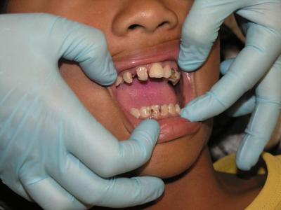 坏牙, 牙痛, 牙科治疗
